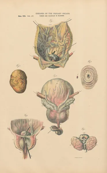 Cystitis. Tumor and uric acid calculus in the bladder av Jean Allard Jeancon