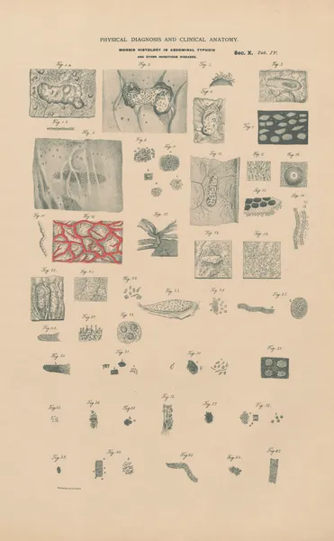 Morbid histology of abdominal typhoid, scarlet fever. Tuberculosis, Gangrene &c. av Jean Allard Jeancon